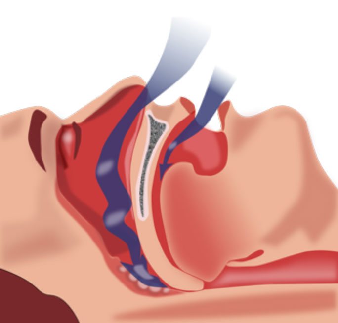 A blocked airway, or when the soft palate located in the back of the mouth collapses against the throat, causes obstructive sleep apnea.